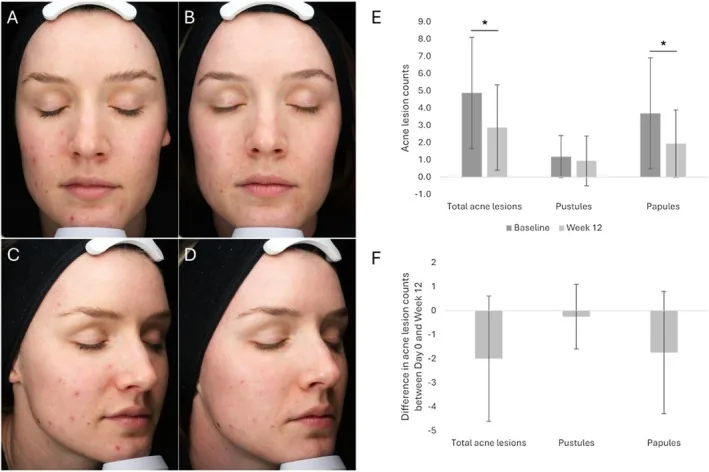 Facial photographs before and after twelve weeks of chemical peel sessions for acne with a chart of falling spot counts, a stronger option than a home exfoliator for acne