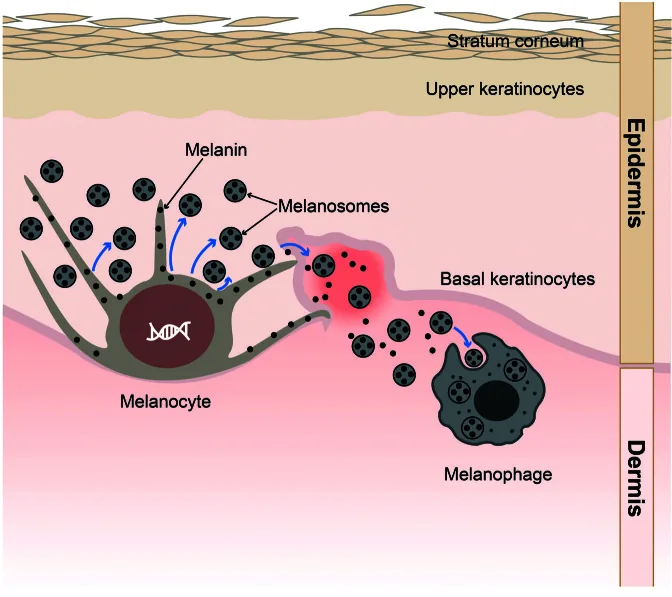 Diagram of the skin layers showing a pigment cell producing melanin and passing it to skin cells, with some pigment leaking into the dermis where immune cells pick it up, explaining the dark marks left by spots