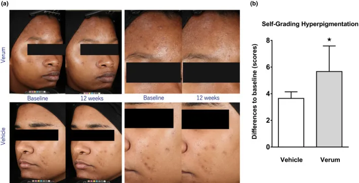 Photographs of two people with dark skin and marks after spots at baseline and after twelve weeks, with the active product and the product without the active ingredient, plus a chart of participants' ratings, showing that a tested daily product does more than a mask for acne marks