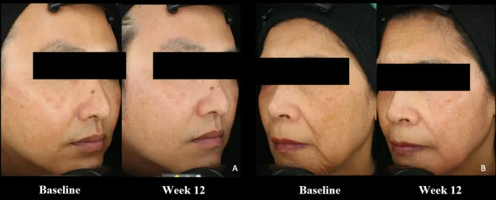 Two patients with melasma at baseline and after twelve weeks on the side treated with alpha-arbutin and kojic acid cream and on the triple combination cream side, ingredients close to those in Alpha Plus lightening cream
