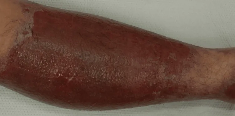A leg with well-demarcated redness matching the area of a dressing under which antibiotic ointment was applied, the appearance of contact allergy to antibiotic ointment