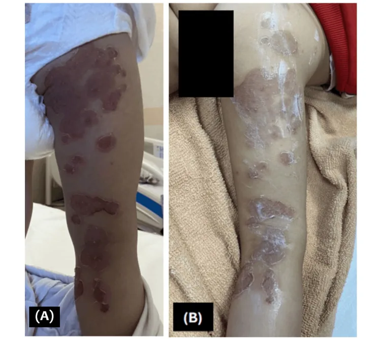 A child's leg with shallow sores from bullous impetigo improving over days of treatment, an example of a skin infection where antibiotic ointment may be used alongside other treatment