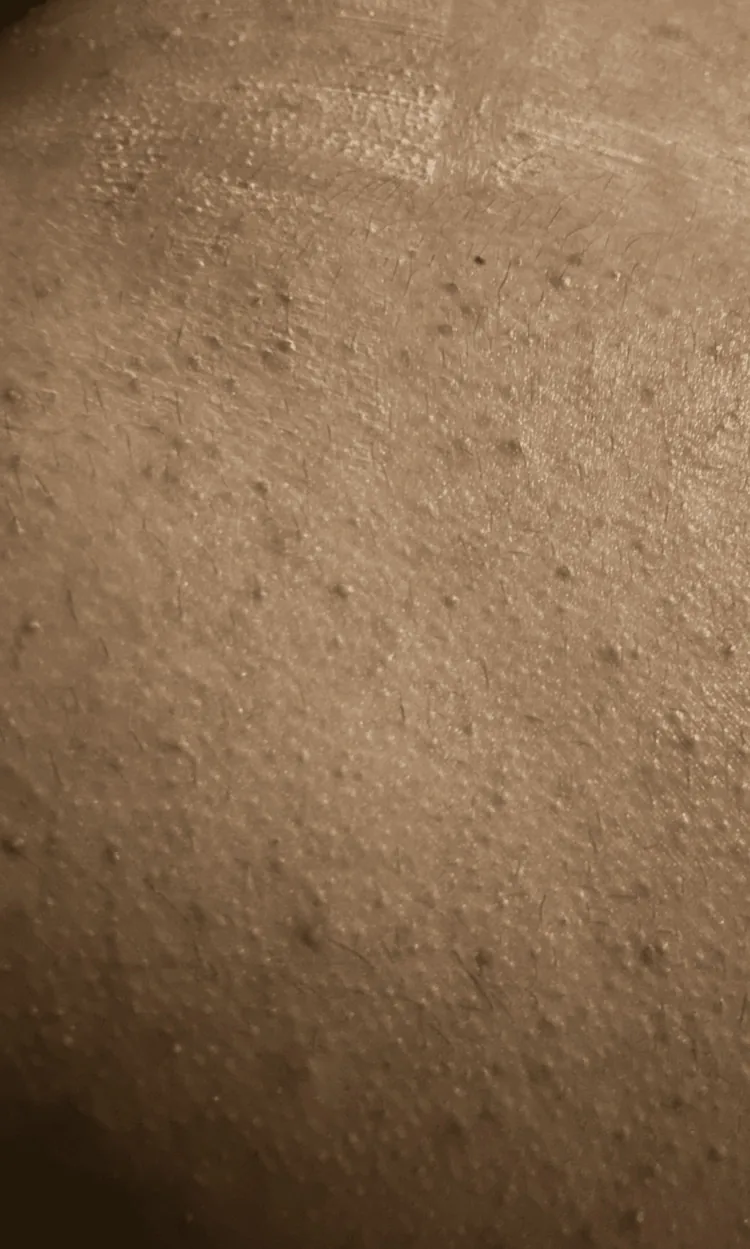 Small papules and pustules clustered around hair follicles on the lower back in bacterial folliculitis, one form of bacterial pimples
