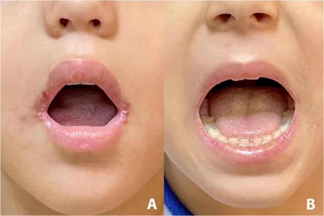 Cracked mouth corners in a child without dexpanthenol ointment compared with healthy mouth corners in a child who had it applied before surgery, the active ingredient in Bepanthen