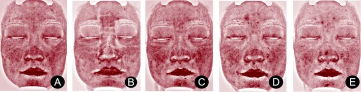 Analysis images of the face showing the red area shrinking over two weeks with a mask containing panthenol, the active ingredient in Bepanthen, after laser