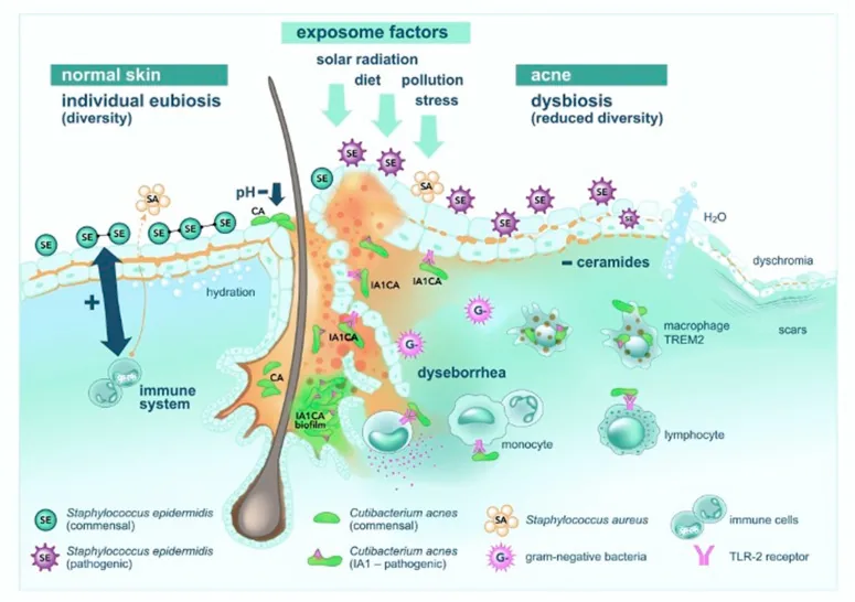 Diagram comparing normal skin with diverse bacteria and acne-affected skin with reduced diversity, more oil and inflammation and fewer ceramides, explaining the microbiome claims of Bioderma's acne products