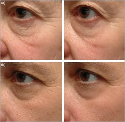 Close-up photographs of the outer eye area before and after eight weeks of treatment with a cosmetic regimen and with tretinoin, two topical Botox alternatives for fine wrinkles