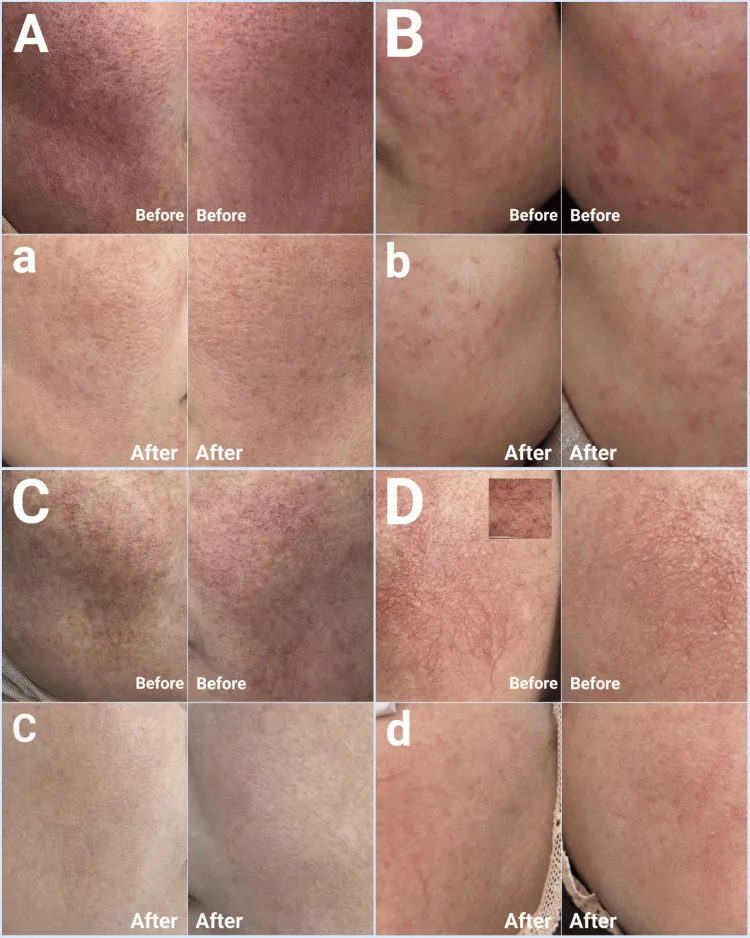 Close-up photos of cheek skin showing redness, small bumps and visible vessels in steroid-induced rosacea, which can be mistaken for acne on cheeks