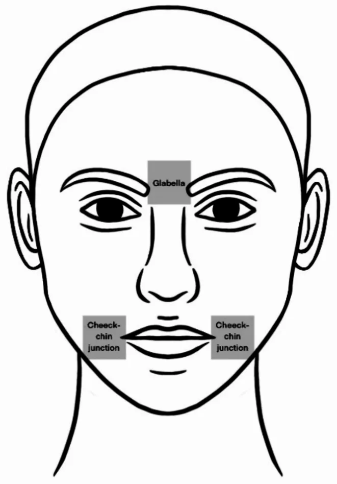 Face diagram marking the area between the eyebrows and the cheek-chin junction under the edge of a mask, where acne on cheeks appears