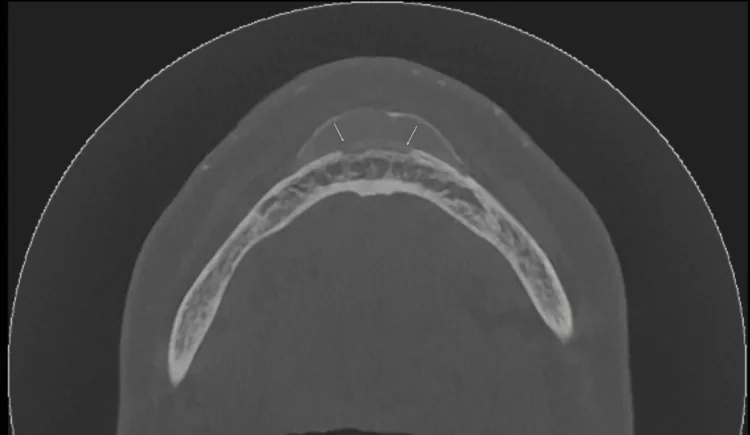 An axial cone-beam CT slice of the lower jaw with arrows showing erosion of the front bone cortex beneath a chin augmentation site