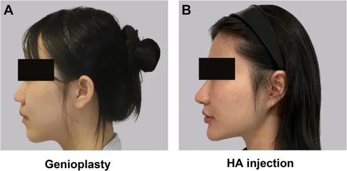 Two side profiles of women one year after treatment, one after sliding genioplasty and the other after hyaluronic acid chin filler