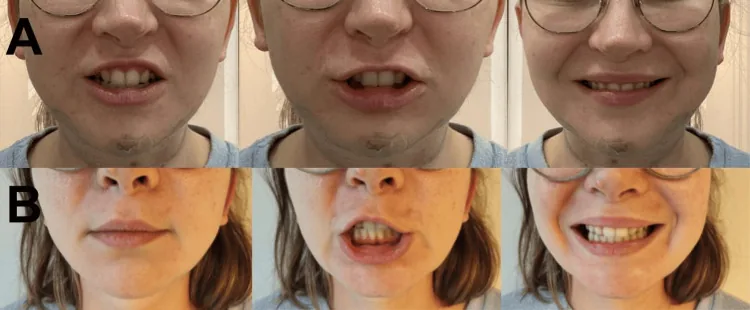 The lower face of a woman showing restricted downward movement of the lower lip when smiling after chin augmentation, then recovered movement