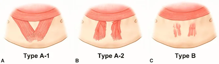 Illustration of three shapes of the chin muscle, dome-shaped and joined, dome-shaped and separate, and flat and thin, the muscle that creates chin wrinkles and dimpling