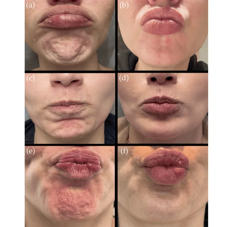 Photographs of three people's chins with clear dimpling as the chin muscle contracts, then a smoother surface after toxin injection, a treatment for chin wrinkles