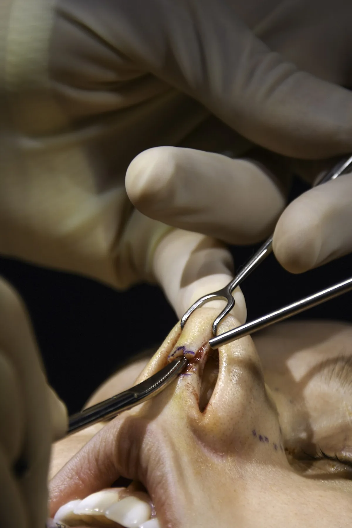 A small columellar incision between the nostrils during open rhinoplasty, with instruments lifting the skin of the nasal tip