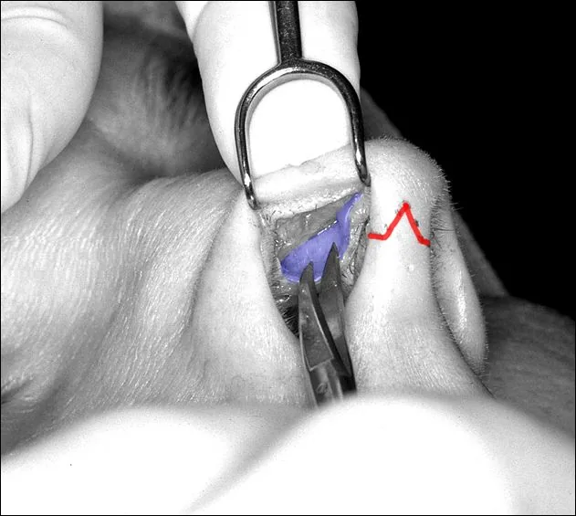 The underside of the nose during rhinoplasty showing the internal rim incision in blue and the external columellar incision in red that open rhinoplasty adds and closed rhinoplasty avoids