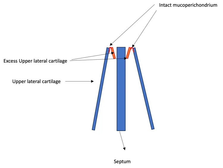 Diagram of a cross-section of the nose showing the central septum and the two upper lateral cartilages with their excess folded inwards to support the airway in closed rhinoplasty