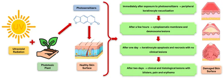 Diagram of plant substances reacting with ultraviolet light on skin and the stages of damage up to blisters and redness, explaining why mixing coconut oil with lemon for lightening can cause dark patches