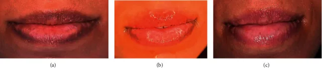 Dark lips before a laser session, then mild swelling after it, then a lighter colour after complete healing, an option for dark lips once the cause has been removed