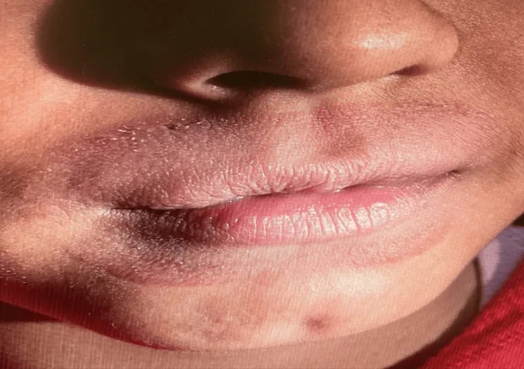 Dry, irritated and slightly darkened skin around the lips of a child who habitually licked them, a common cause of darkening around the lips treated by stopping the habit, not with home remedies