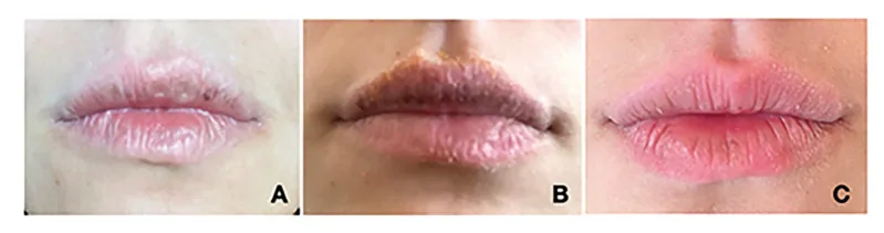 Three photographs of a young woman's lips showing multiple grey patches from an allergy to a dye in a lip product, then improvement after stopping it, a cause of dark lips that a home remedy won't fix