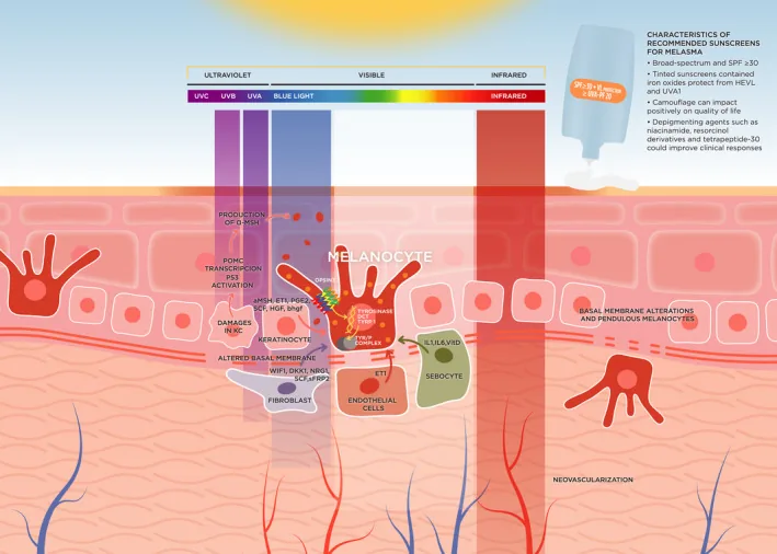 Diagram of the skin layers under ultraviolet, visible and infrared light, showing how pigment cells are stimulated in melasma and why a dark forehead needs a tinted sunscreen