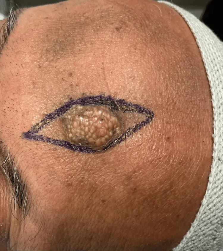 Photograph of a man's forehead showing a raised plaque marked for excision, with mild pigmentation and thickening of the skin on the other side of the forehead from repeated friction during prayer, illustrating one cause of a dark forehead
