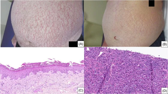 Skin of the trunk covered in a network of red inflamed cracks resembling crazy paving, characteristic of asteatotic eczema