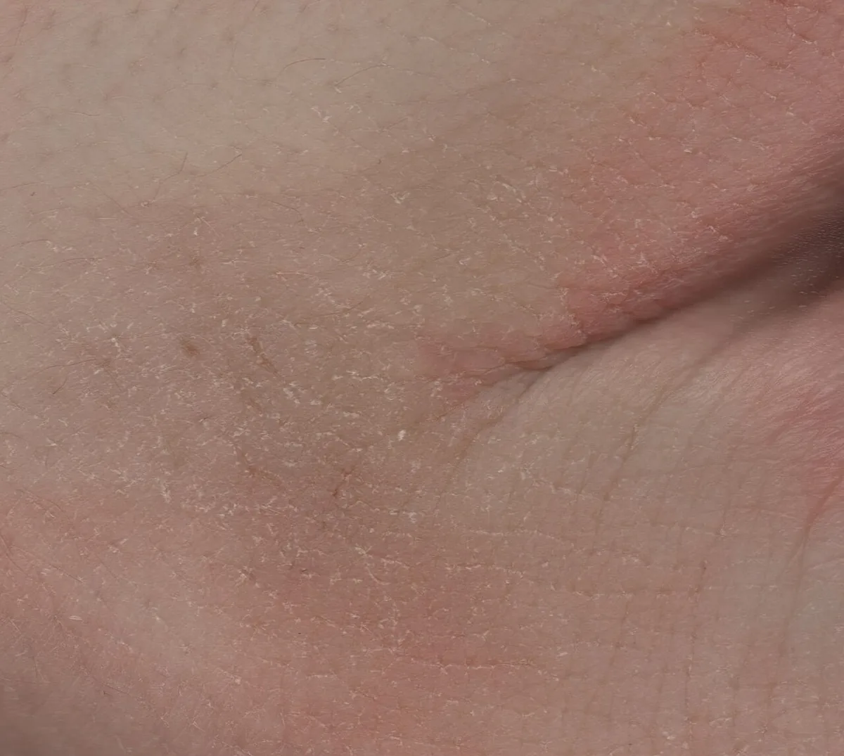 Dry skin with fine white scale and no obvious inflammation, typical of winter dry skin on the body