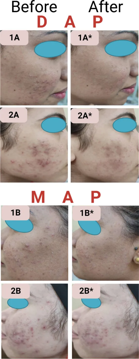 Side views of patients' faces before and after adapalene gel treatment, showing fewer inflamed spots, with the eyes masked