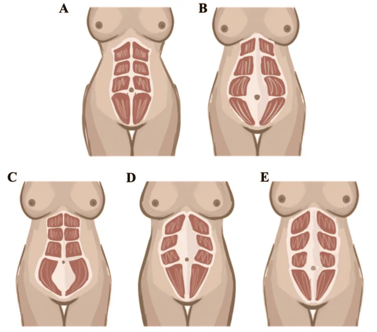 Illustrations of five patterns of separation of the rectus abdominis muscles from the midline, which differ from the skin laxity that excess skin removal treats