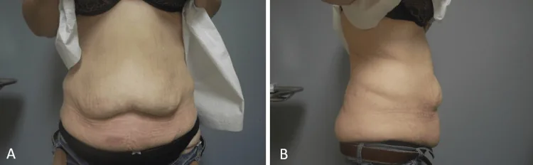 Excess abdominal skin hanging in folds over the lower abdomen, seen from the front and side, before excess skin removal after bariatric surgery