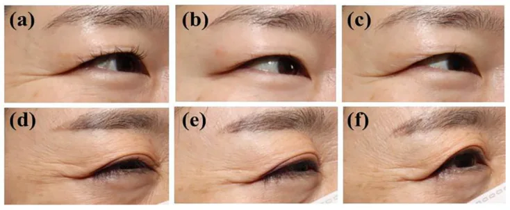 Close-up photos of the outer eye while smiling showing crow's feet softening after botulinum toxin compared with placebo, which eye wrinkle exercises don't achieve