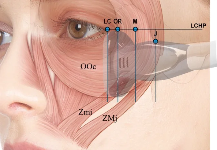 Anatomical illustration of the ring muscle around the eye, over which the skin folds when smiling and forms the wrinkles targeted by eye wrinkle exercises