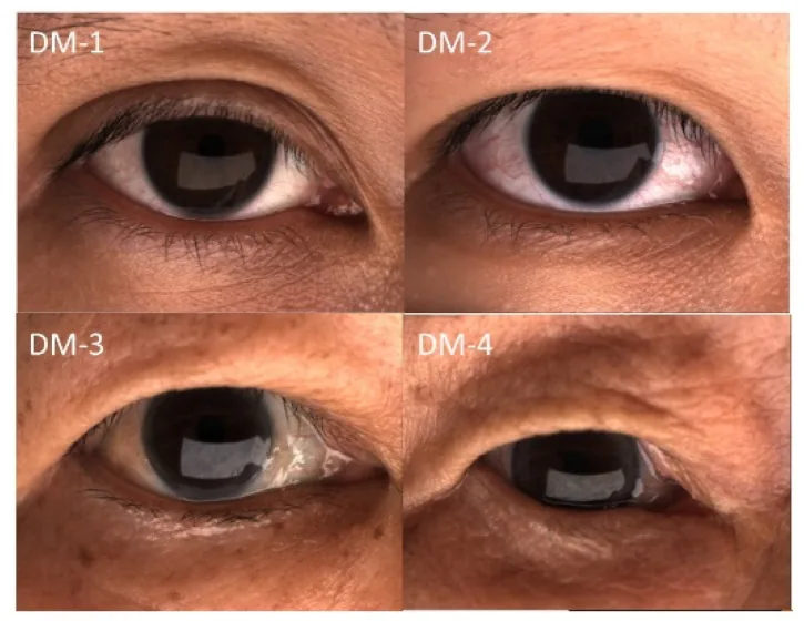 Four grades of excess upper eyelid skin, from a mild fold to skin covering part of the eye, the condition upper eyelid surgery treats