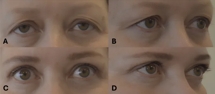 A woman's eyes before skin-only upper eyelid surgery and four months afterwards, with a clearer crease and lighter-looking lids