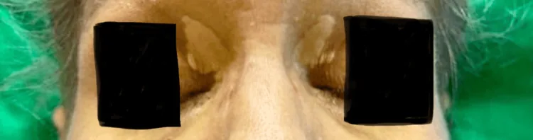 Yellow plaques on the inner part of both upper eyelids, known as xanthelasma, which should be assessed before considering upper eyelid surgery