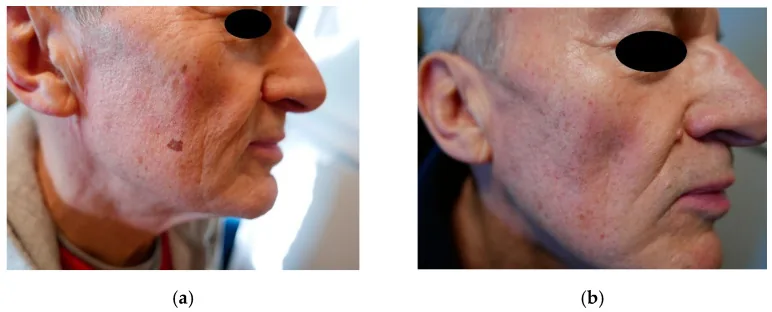 Side view of a patient's face with a brown sun spot on the cheek before laser treatment and its disappearance afterwards, the fastest way to remove this type of pigmentation from the face