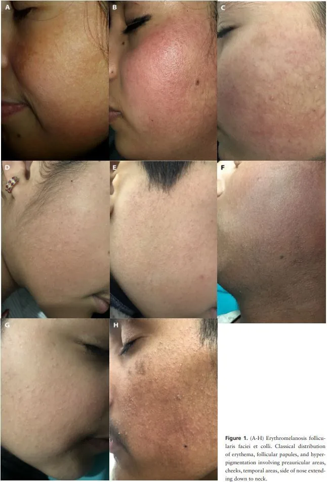 Photographs of the sides of patients' faces with redness, pigmentation and small bumps at the hair follicles in front of the ear, on the cheeks and temples and extending to the neck, illustrating one cause of darkening on the sides of the face