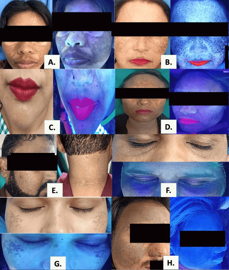 Photographs of faces with different types of facial pigmentation, such as melasma, lichen planus pigmentosus, acanthosis nigricans, periorbital pigmentation and naevus of Ota, in normal light and under a Wood's lamp, showing that darkening on the sides of the face has several causes
