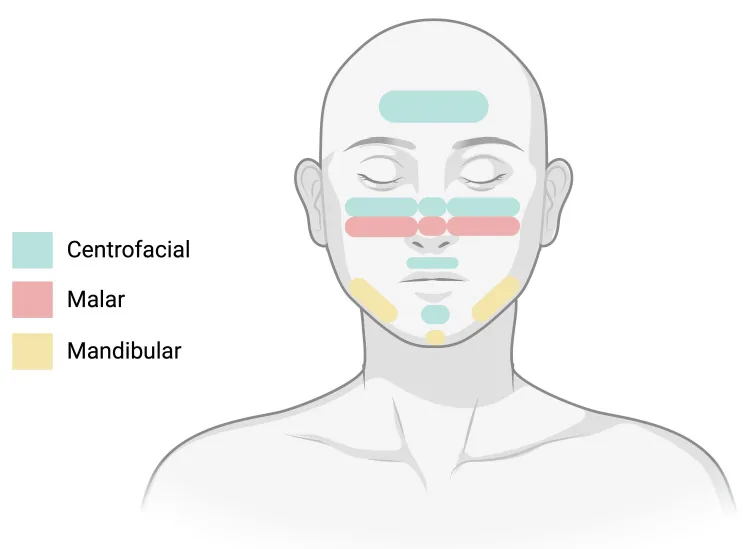 Drawing of a face showing melasma distribution patterns: centrofacial on the forehead, cheeks and nose, malar on the cheeks, and mandibular along the sides of the jaw, explaining why darkening on the sides of the face is often melasma