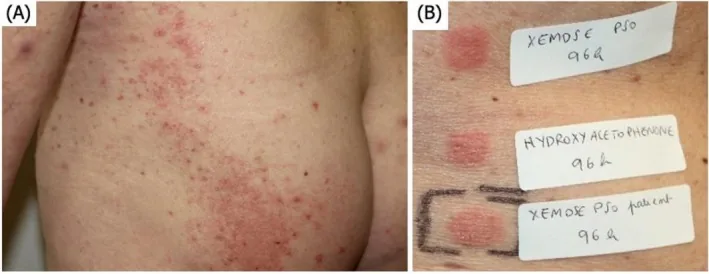 A red rash of small bumps on the skin after a skincare product, and a patch test reading showing red patches under the product and the causative ingredient, an example of allergy causing skin inflammation