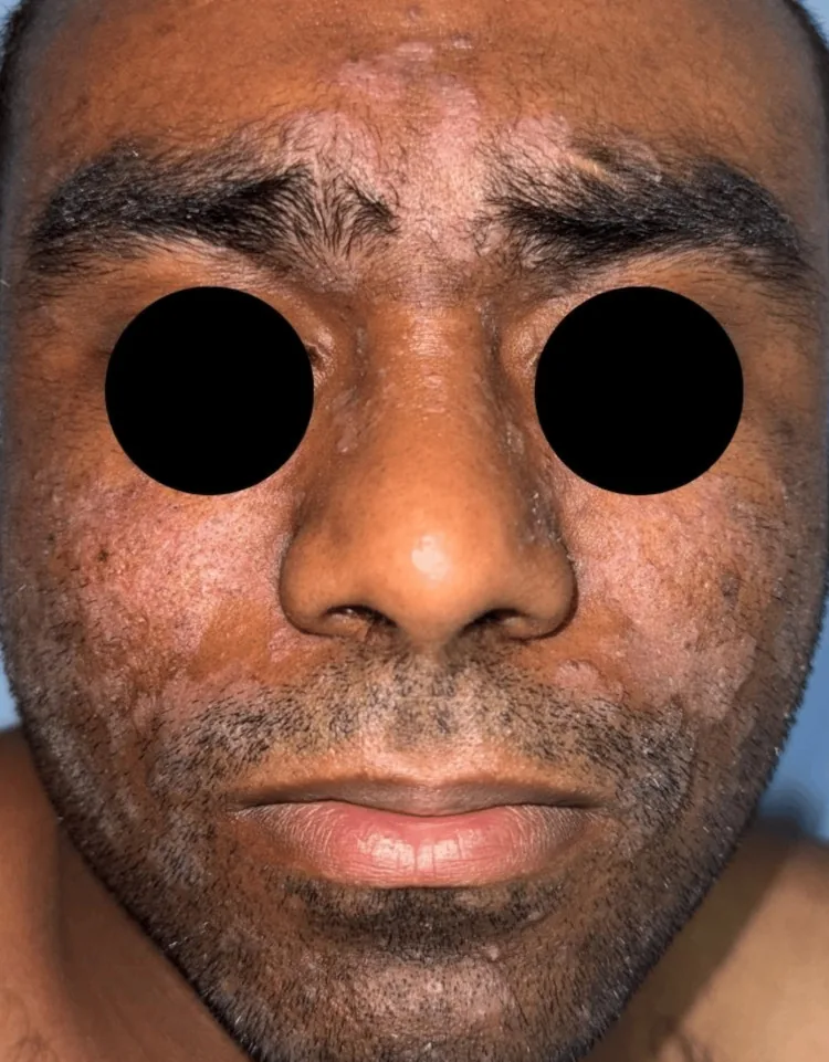 A man's face with red, scaly plaques on the eyebrows, between the brows, beside the nose, on the cheeks and in the beard area, the typical distribution of seborrhoeic dermatitis as a cause of facial skin inflammation