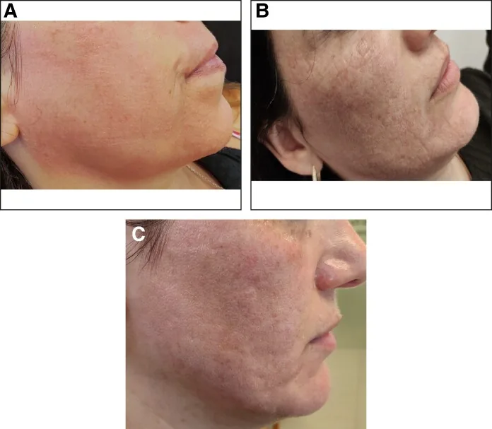 Side of a face after glycolic acid, with redness, then white patches, then both settling after the acid was neutralised, the skin reaction a dermatologist watches during a fruit acid peel for the face