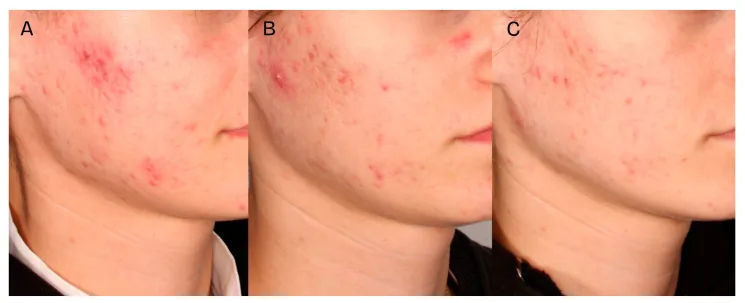 Side of a face with acne before peeling, four weeks after, and two months after two sessions, in a protocol combining glycolic acid with other acids as in a fruit acid peel