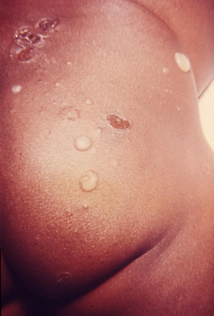 Thin blisters and crusted erosions on the skin in bullous impetigo, a superficial bacterial infection Fusiderm ointment is used for