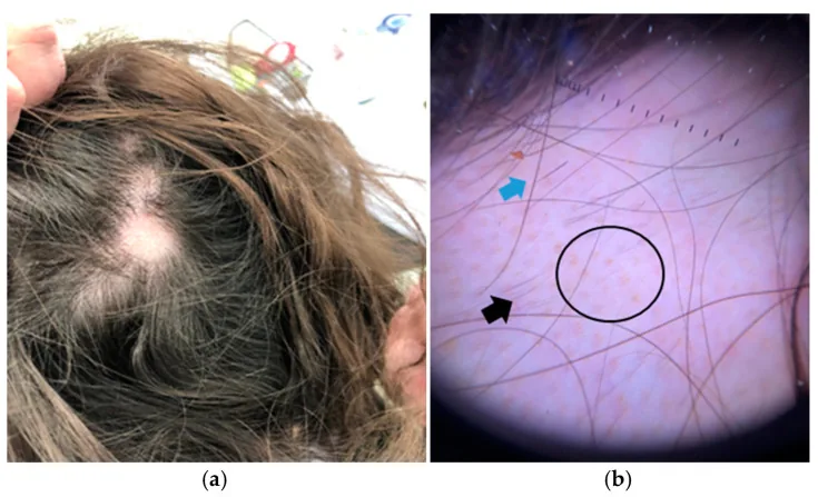 A bald patch on the crown of a woman's head and a dermatoscope image showing yellow dots and short broken hairs, signs that need a dermatologist rather than a hair specialist