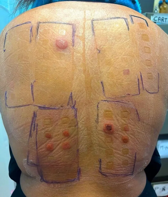 A person's back with a patch test showing red, swollen reactions to hair dye ingredients, an allergy that needs a dermatologist rather than a hair colour specialist