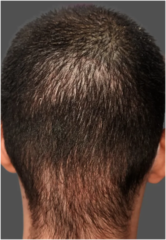 The back of a scalp after a hair transplant showing a clearly thinned patch caused by overharvesting of the donor area