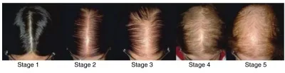 Five stages of female pattern hair loss seen from above, from a widening parting to diffuse crown thinning, relevant before considering a hair transplant in Turkey